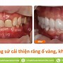 Chấn Thương Tiếng Anh Là Gì